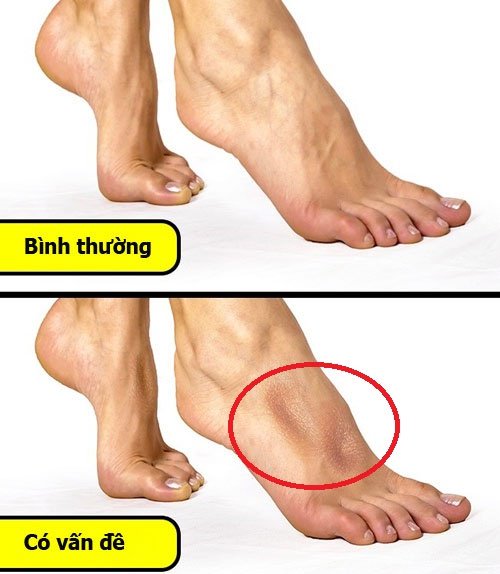 Để biết cơ thể có gặp vấn đề này không bạn kiễng 2 bàn chân lên chỉ đứng bằng mũi chân. 